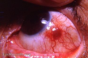 Fundus OD